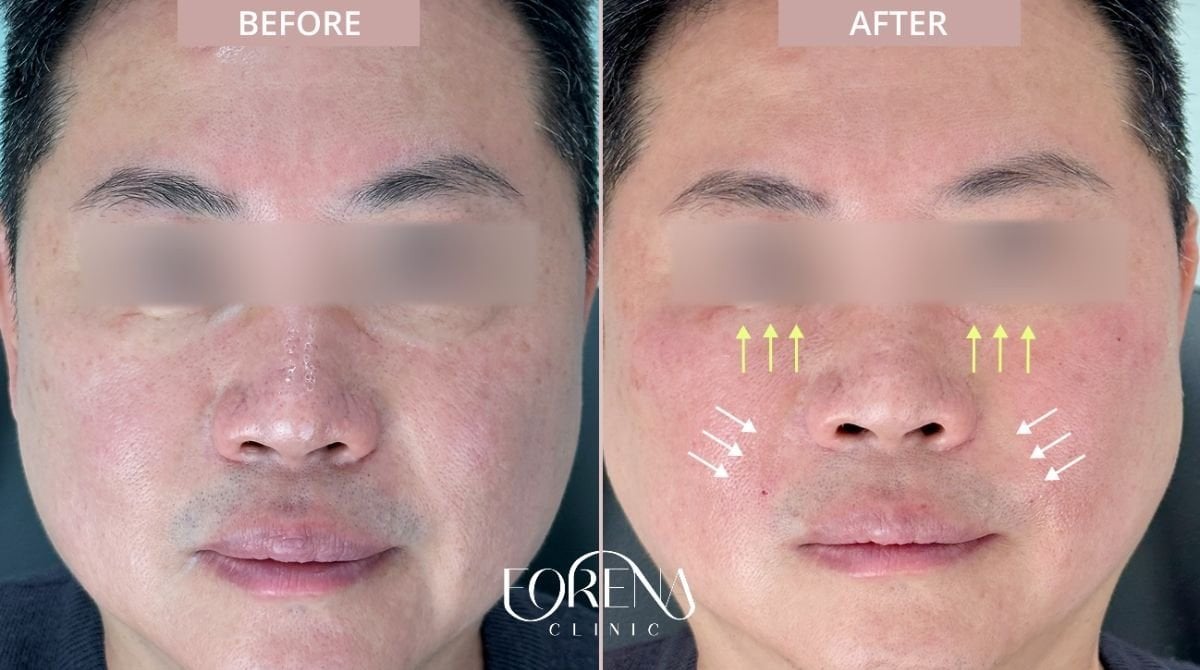 Resultados antes y después de rellenos faciales en Forena Clinic, aumento de volumen facial