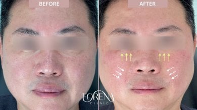 Before and after fillers injection at Forena Clinic, facial volume enhancement result