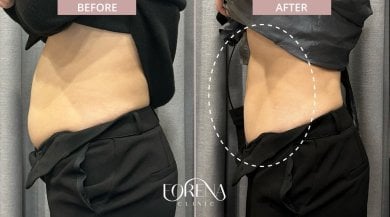 Before and after BodyTite body contouring results at Forena Clinic, visible slimmer abdomen
