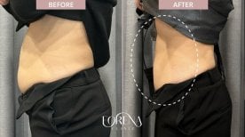Before and after BodyTite body contouring results at Forena Clinic, visible slimmer abdomen