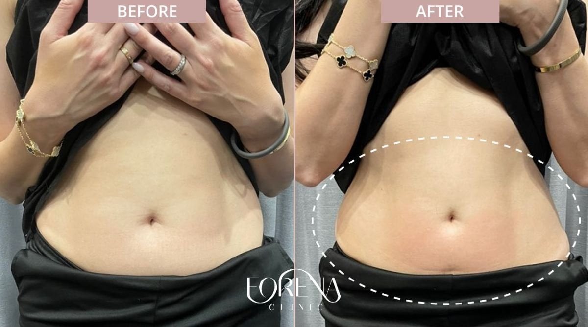 Результаты до и после контурирования тела BodyTite в Forena Clinic, видимое похудение живота