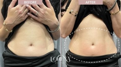 Before and after BodyTite body contouring results at Forena Clinic, visible abdomen slimming
