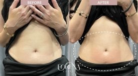 Before and after BodyTite body contouring results at Forena Clinic, visible abdomen slimming