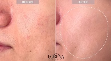 Before and after stem cell rejuvenation therapy result at Forena Clinic, smoother facial skin