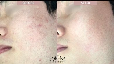 Before and after stem cell rejuvenation therapy at Forena Clinic – improved facial skin texture result