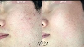 Before and after stem cell rejuvenation therapy at Forena Clinic – improved facial skin texture result