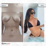 Результаты до и после увеличения груди в CE International Hospital, увеличенный бюст