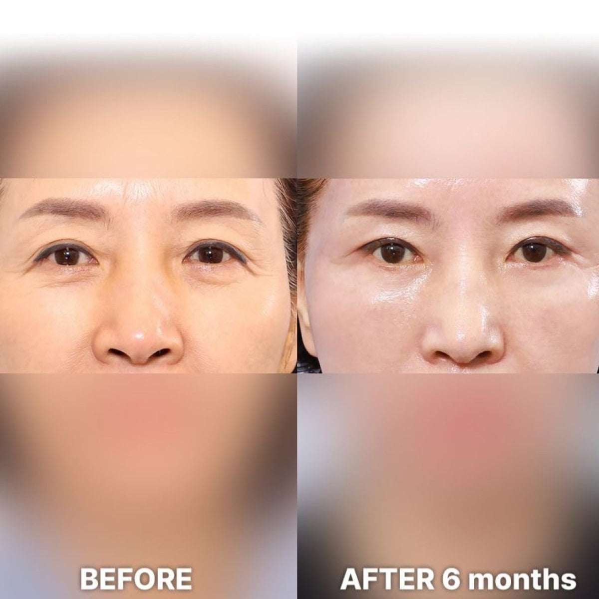 نتائج جراحة الجفن العلوي قبل وبعد في Returning Plastic Surgery بعد 6 أشهر