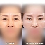 Upper eyelid surgery before and after results at Returning Plastic Surgery, 6 months post-op