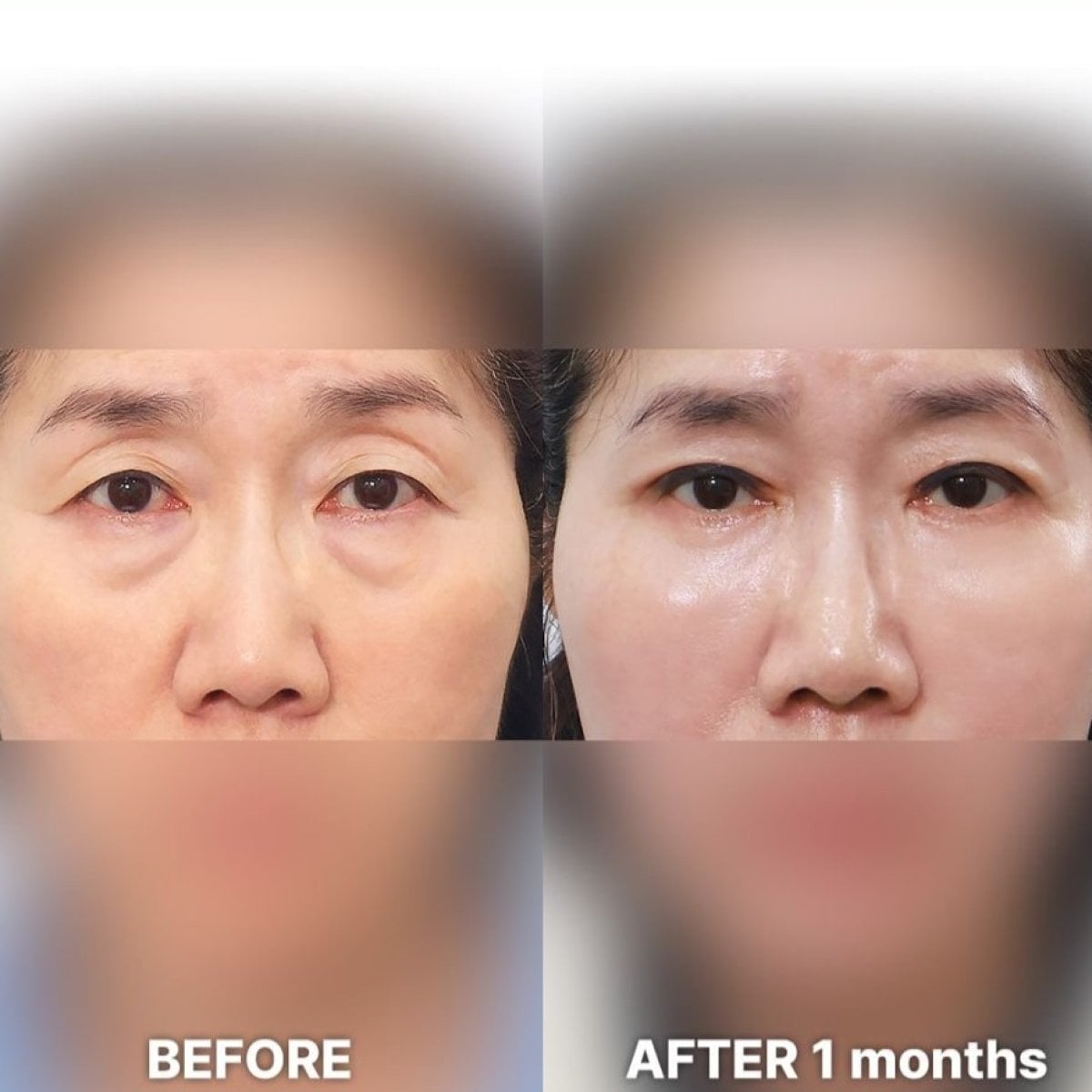 نتائج شد الجفن العلوي قبل وبعد في Returning Plastic Surgery، تحسين محيط العين
