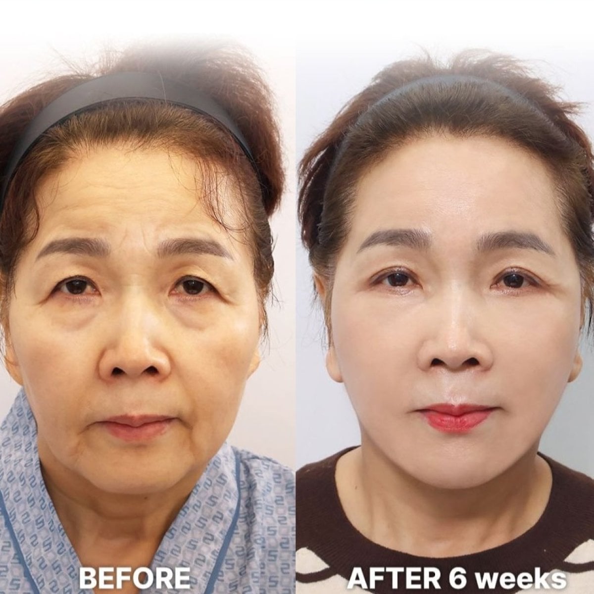 نتائج جراحة الجفن العلوي قبل وبعد في Returning Plastic Surgery بعد 6 أسابيع