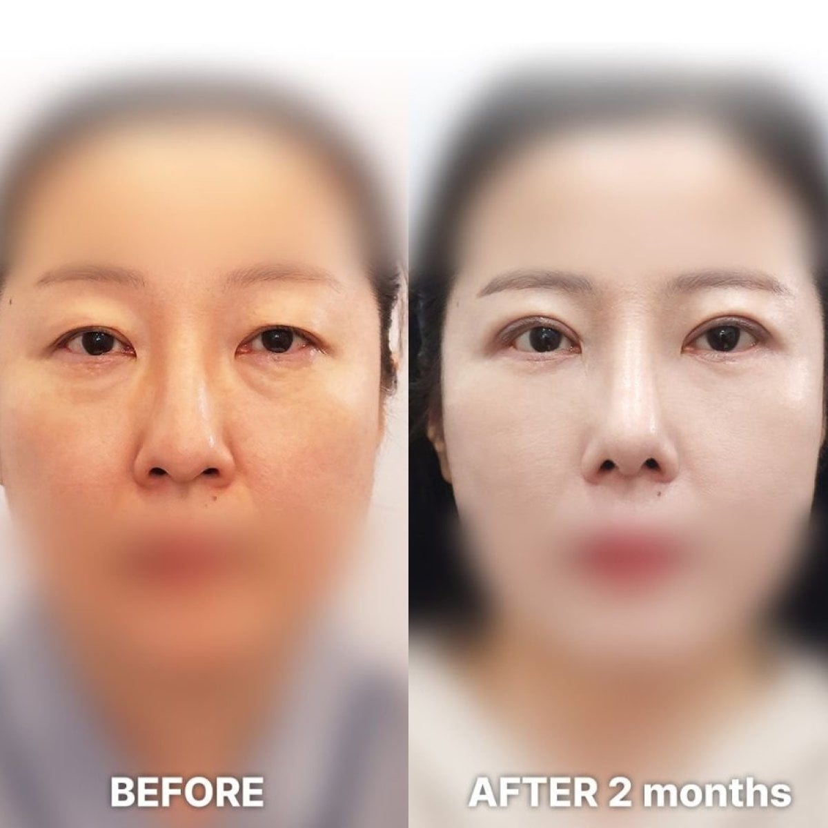 نتائج جراحة الجفن العلوي قبل وبعد في Returning Plastic Surgery بعد شهرين