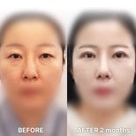 Upper eyelid surgery before and after results at Returning Plastic Surgery, 2 months post-op