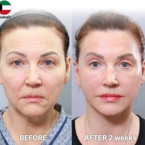 Lower eyelid blepharoplasty before and after results at Returning Plastic Surgery clinic