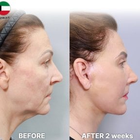 Before and after lower eyelid blepharoplasty at Returning Plastic Surgery, visible eye area result