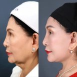 Before and after mini facelift results at Dr. Chen Surgery Hospital International Center, facial rejuvenation