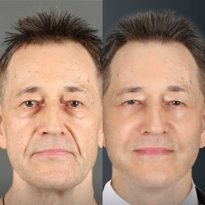 Before and after mini facelift results at Dr. Chen Surgery Hospital International Center, face rejuvenation