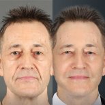 Before and after mini facelift results at Dr. Chen Surgery Hospital International Center, face rejuvenation