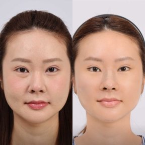 Before and after mini facelift results at Dr. Chen Surgery Hospital International Center, face lift