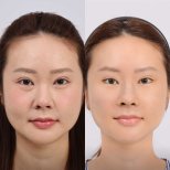 Before and after mini facelift results at Dr. Chen Surgery Hospital International Center, face lift
