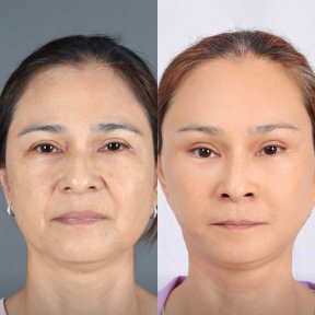 Before and after mini facelift results at Dr. Chen Surgery Hospital International Center, facial rejuvenation