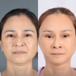 Before and after mini facelift results at Dr. Chen Surgery Hospital International Center, facial rejuvenation