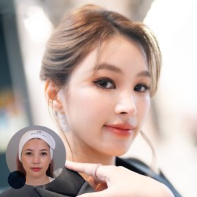 Mini facelift before and after results at Dr. Chen Surgery Hospital International Center