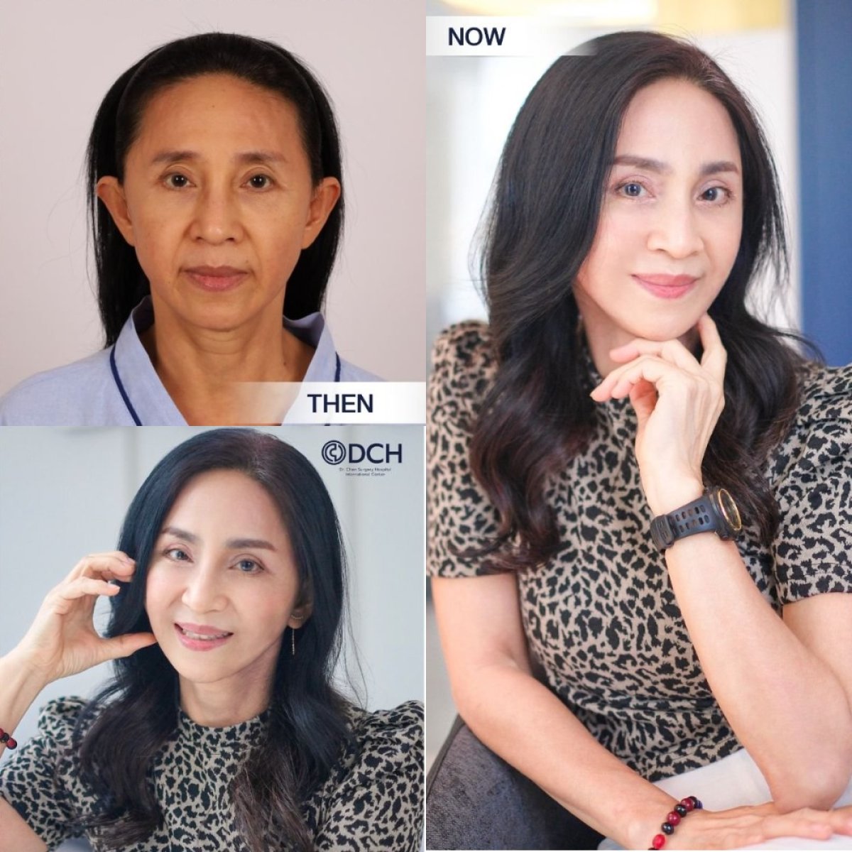 Resultados de minilifting facial antes y después en Dr. Chen Surgery Hospital International Center, rejuvenecimiento