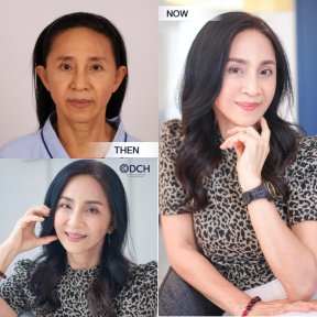 Mini facelift before and after results at Dr. Chen Surgery Hospital International Center, rejuvenation