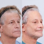 Before and after mini facelift results at Dr. Chen Surgery Hospital International Center, facial rejuvenation