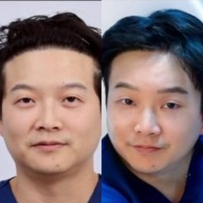 Before and after mini facelift results at Dr. Chen Surgery Hospital International Center