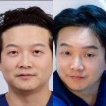 Before and after mini facelift results at Dr. Chen Surgery Hospital International Center