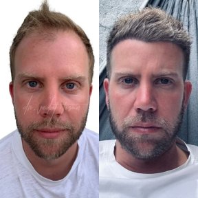 Vorher-nachher-Ergebnisse DHI-Haartransplantation bei Istinye University Liv Hospital Bahcesehir