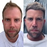 Vorher-nachher-Ergebnisse DHI-Haartransplantation bei Istinye University Liv Hospital Bahcesehir