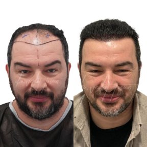 Vorher-nachher-Ergebnis DHI-Haartransplantation in Istinye University Liv Hospital Bahcesehir