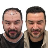Vorher-nachher-Ergebnis DHI-Haartransplantation in Istinye University Liv Hospital Bahcesehir