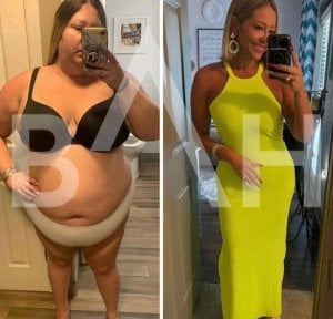 Before and after gastric sleeve surgery results at Büyük Anadolu Hospitals (BAH), weight loss