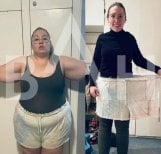 Before and after gastric sleeve surgery results at Büyük Anadolu Hospitals (BAH), significant weight loss