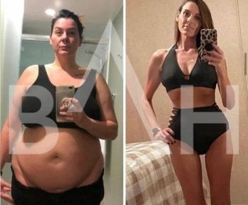 Before and after gastric sleeve surgery results at Büyük Anadolu Hospitals (BAH), weight loss