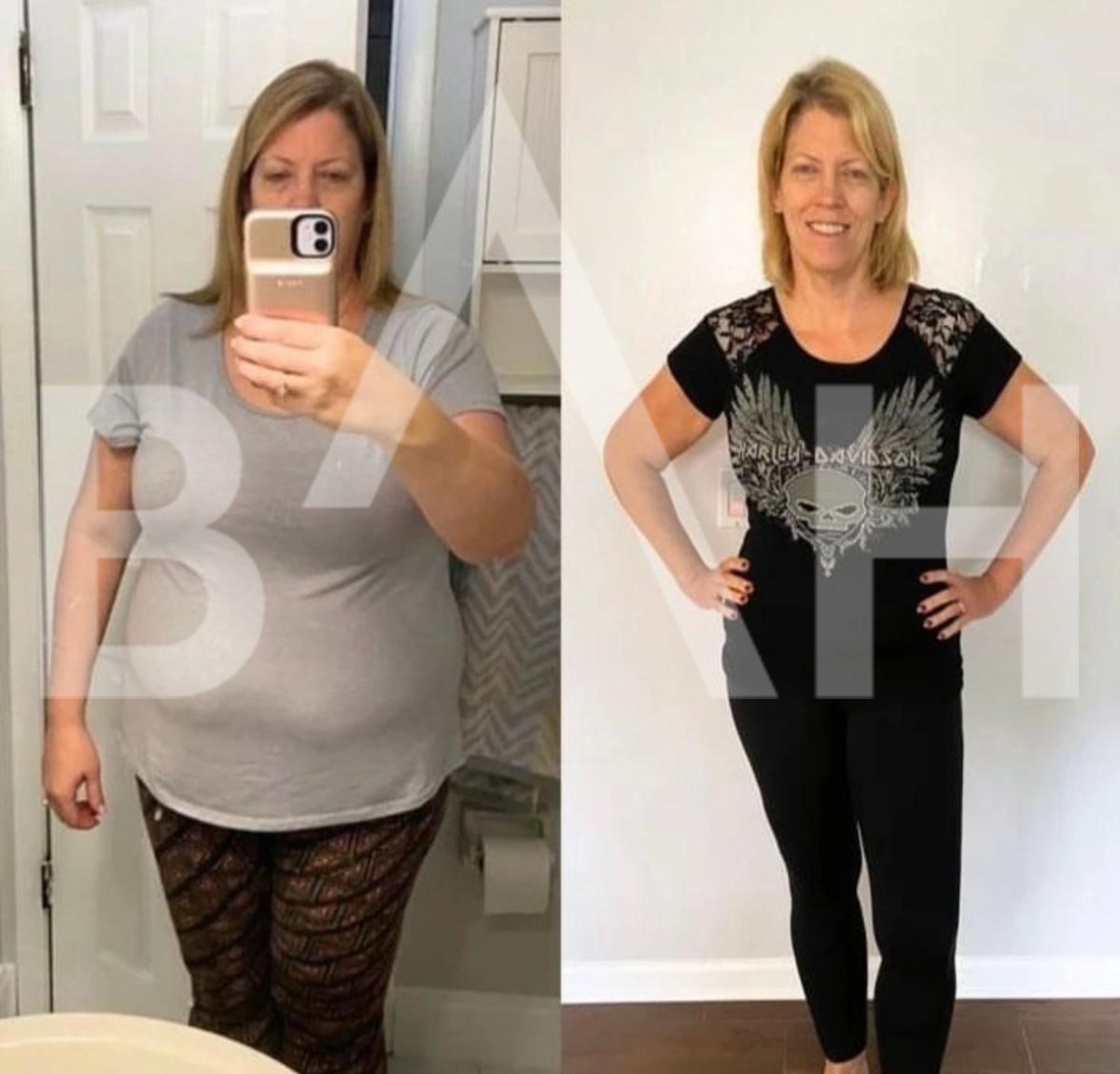 Vorher-nachher-Ergebnis Magenballon bei Büyük Anadolu Hospitals (BAH), sichtbarer Gewichtsverlust