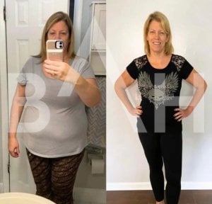 Before and after gastric balloon results at Büyük Anadolu Hospitals (BAH), visible weight loss