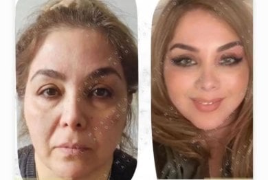 Facelift before and after results at Dr. MED – visible facial rejuvenation and smoother skin