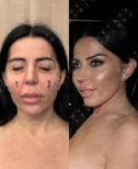Facelift before and after results at Dr. MED – visible facial rejuvenation and contouring
