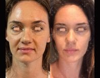 Facelift before and after results at Dr. MED – smoother, youthful facial appearance