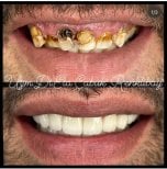 Before and after dental implant results at Dr. Ela Cabuk Renklibay's Private Dental Clinic
