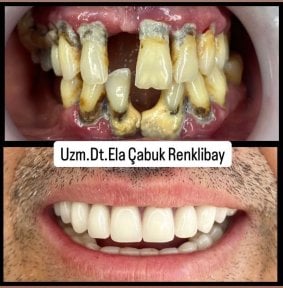 Before and after dental implant results at Dr. Ela Cabuk Renklibay's Private Dental Clinic