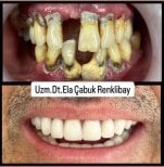 Before and after dental implant results at Dr. Ela Cabuk Renklibay's Private Dental Clinic