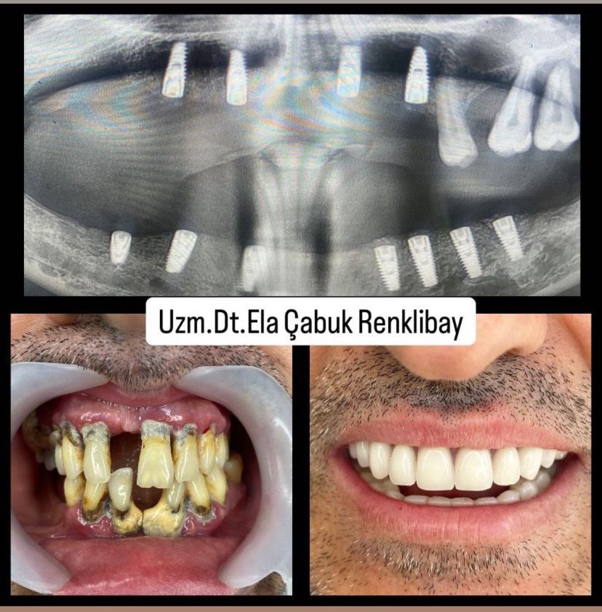 Vorher-nachher-Ergebnisse Zahnimplantate in Dr. Ela Cabuk Renklibays Privatklinik