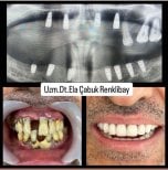 Dental implant before and after results at Dr. Ela Cabuk Renklibay's Private Dental Clinic