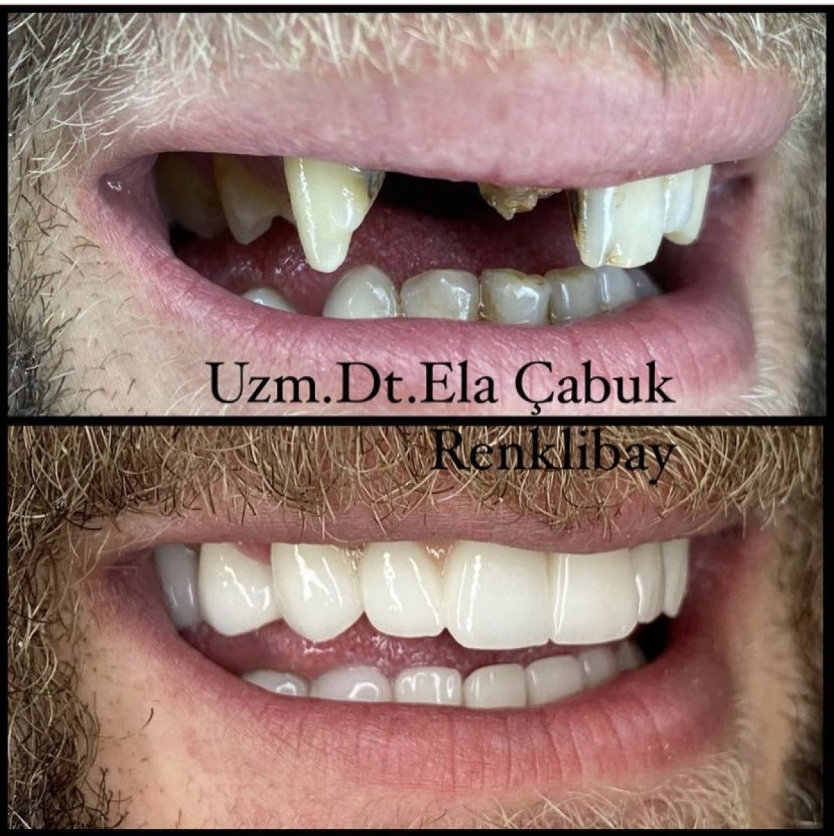 Vorher-nachher-Ergebnis Zahnimplantate in Dr. Ela Cabuk Renklibays Privatklinik